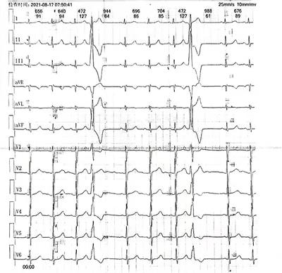 Case Report: A Rare Case of Severe Coronary Venous Spasm During Radiofrequency Ablation of Premature Ventricular Contraction